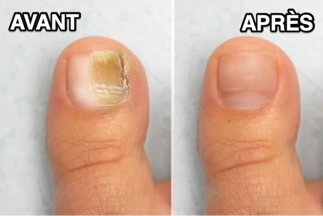 Comment traiter au mieux une mycose sur mes ongles de pieds ?